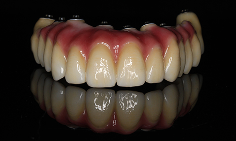 Zahntechnische Arbeit aus der Bildwelt von DENTAL TEAM Bergen